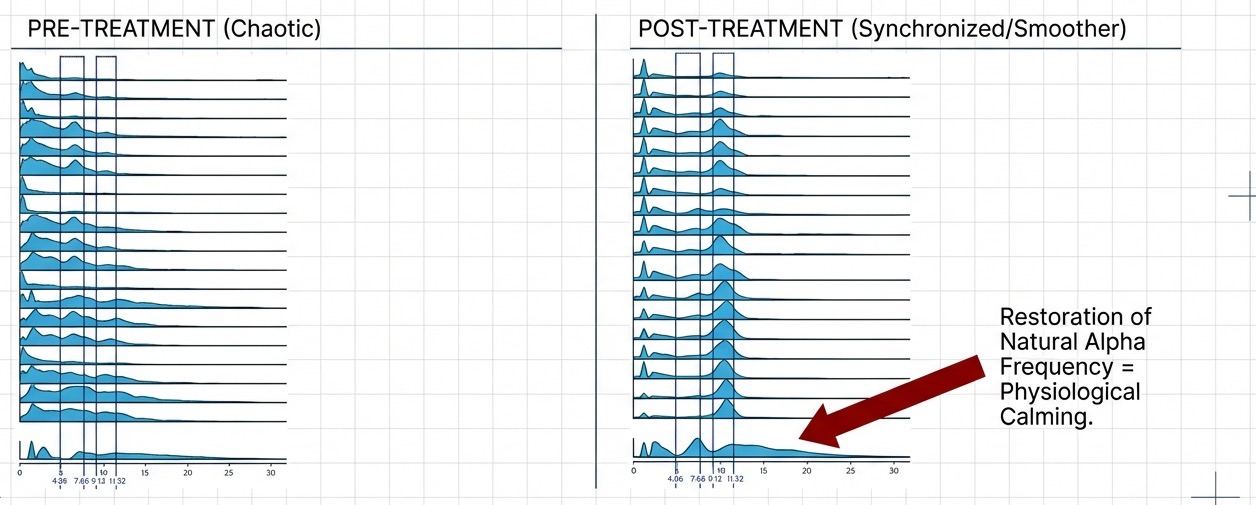 qEEG magnitude spectra before and after MeRT treatment